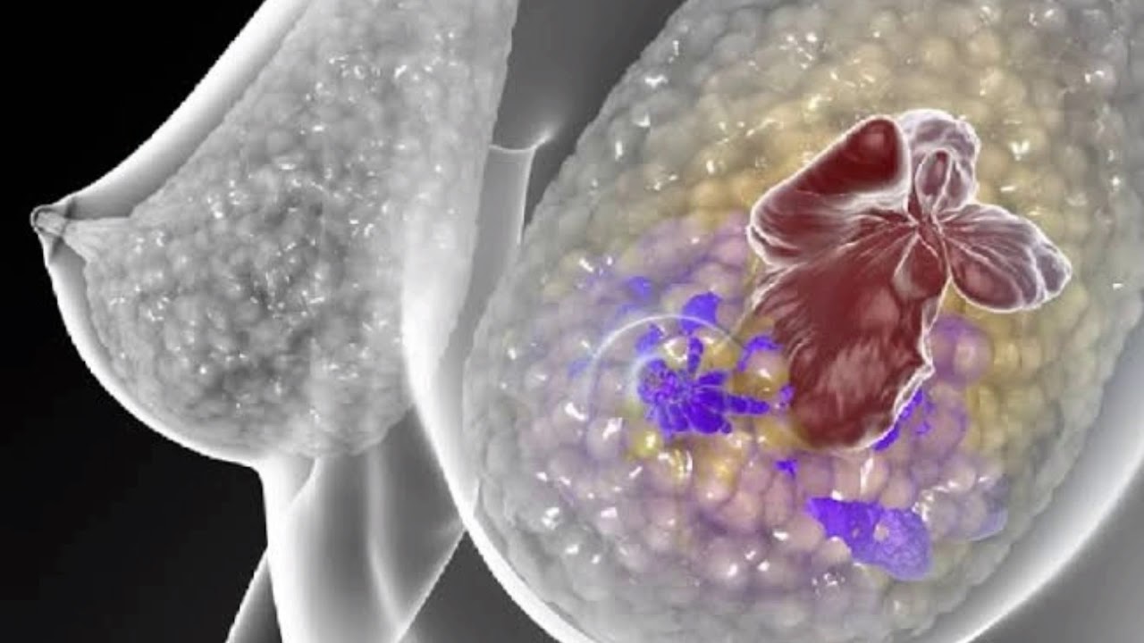 Challenges Met, Solutions Found: Hormone Refractory Breast Cancer Market Dynamics