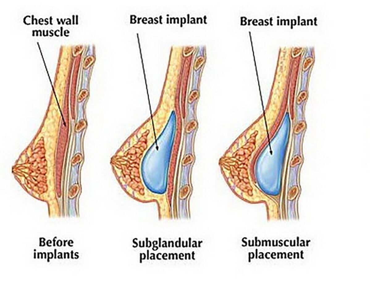 Enhancing Confidence: Exploring the Breast Implants Market