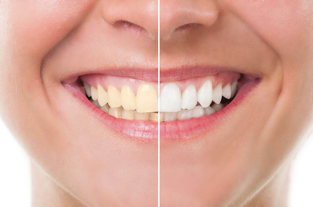 Types of Teeth Whitening Treatments and bright smile