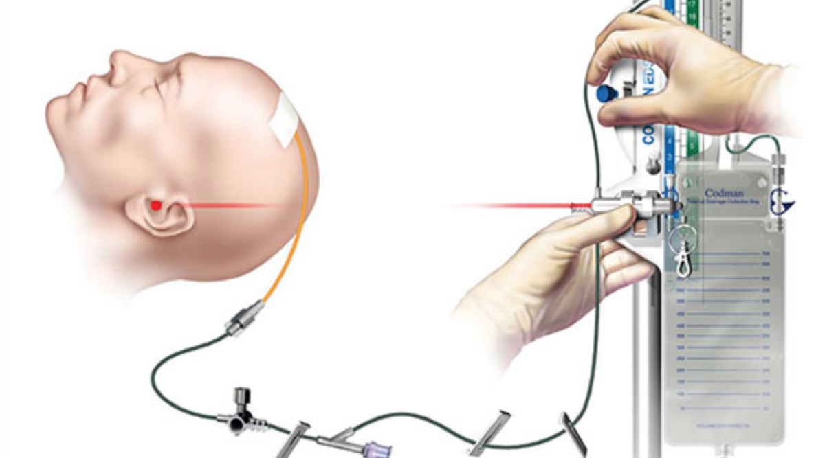 Global External Ventricular Drain Market: Driving Factors and Strategic Insights