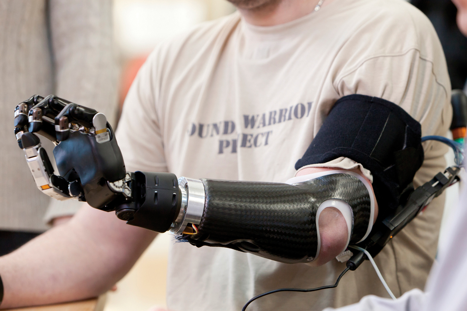 Bionic Prosthetics: An Evolving Revolution in Limb Replacement 