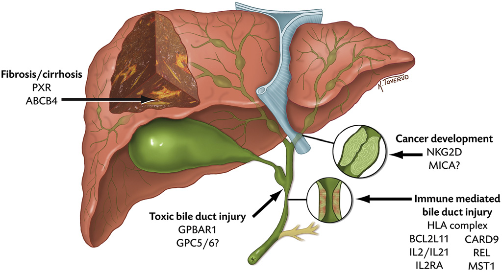 Primary Sclerosing Cholangitis Market is Estimated to Witness High Growth Owing to Opportunity to Treat Associated Symptoms