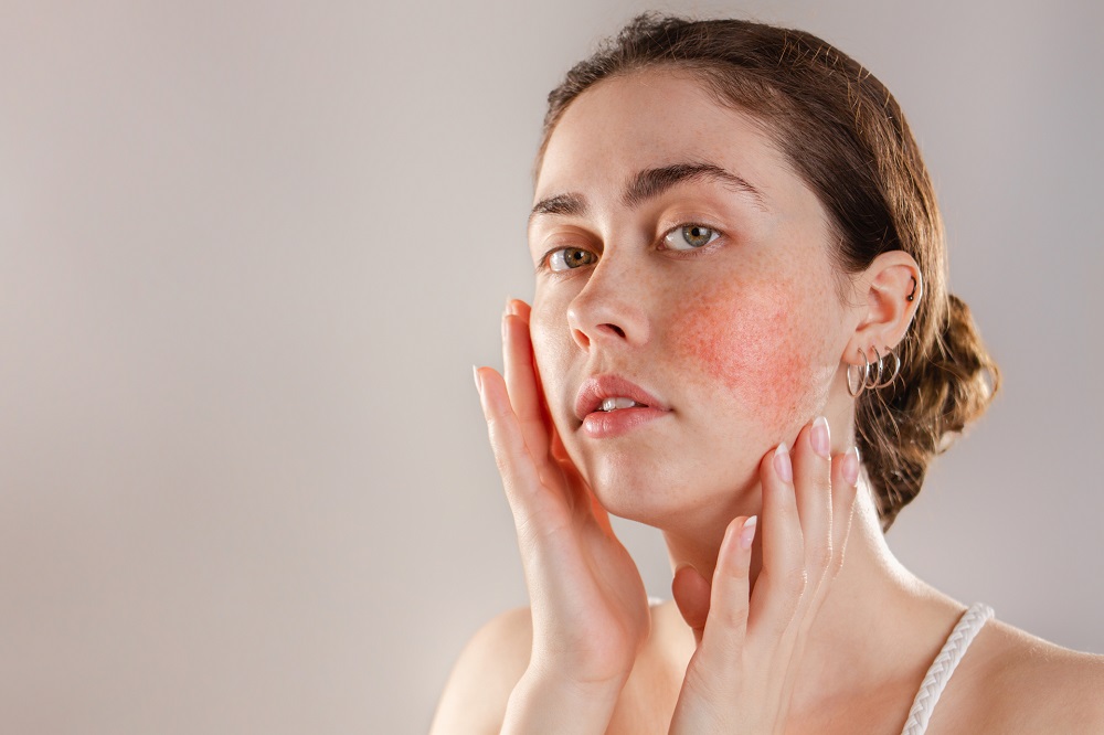 The Rosacea Treatment Market is Estimated to Witness High Growth Owing to Opportunity in Increasing Adoption of Advanced Therapeutics
