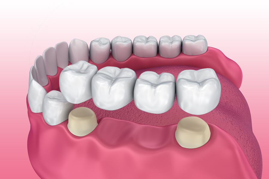 Discover Your Path to a Brighter Smile with Crowns and Bridges in Chembur East