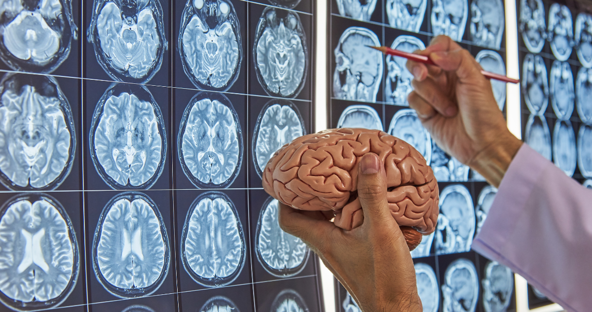 Traumatic Brain Injury Therapeutics Market to Reach US$ 3.46 Billion by 2022