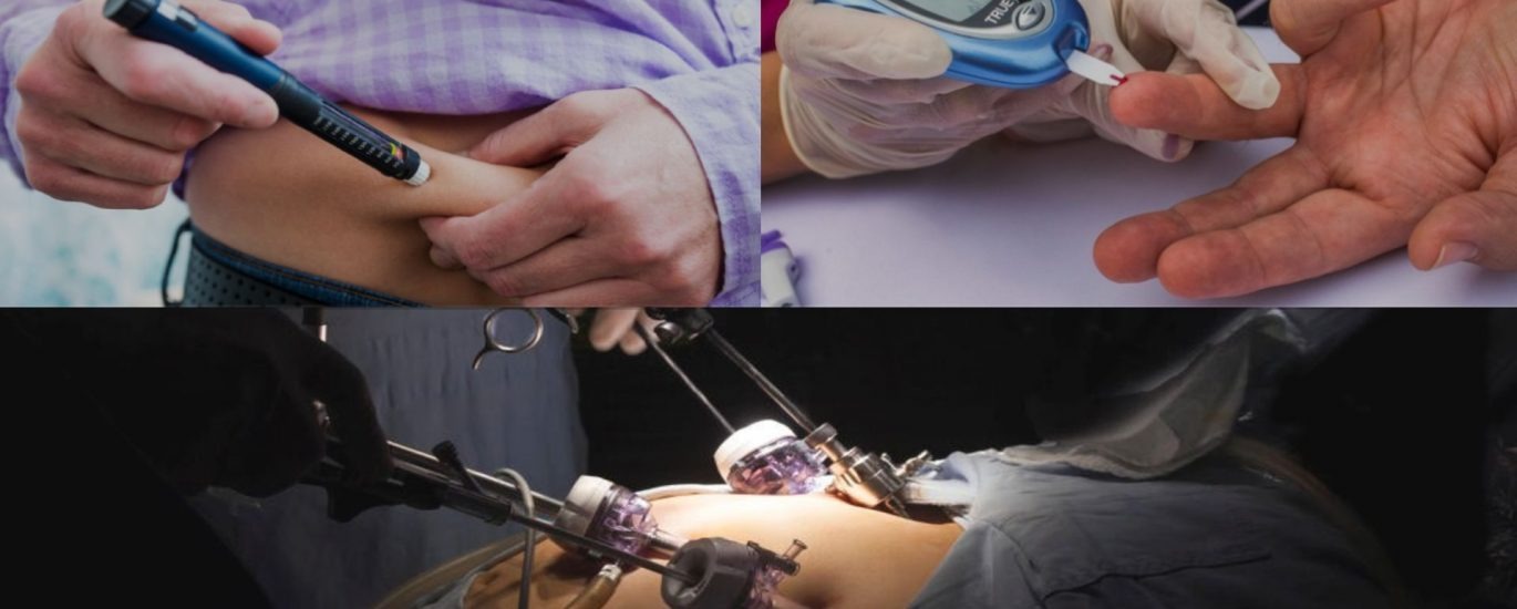 Can metabolic surgery help control diabetes in patients?