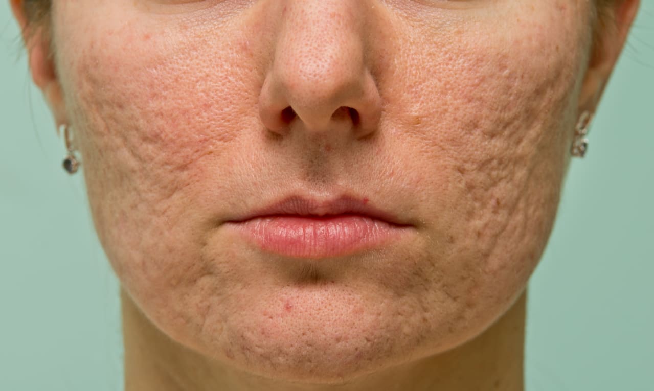 Dubai's Clear Canvas: Scar Removal Marvels
