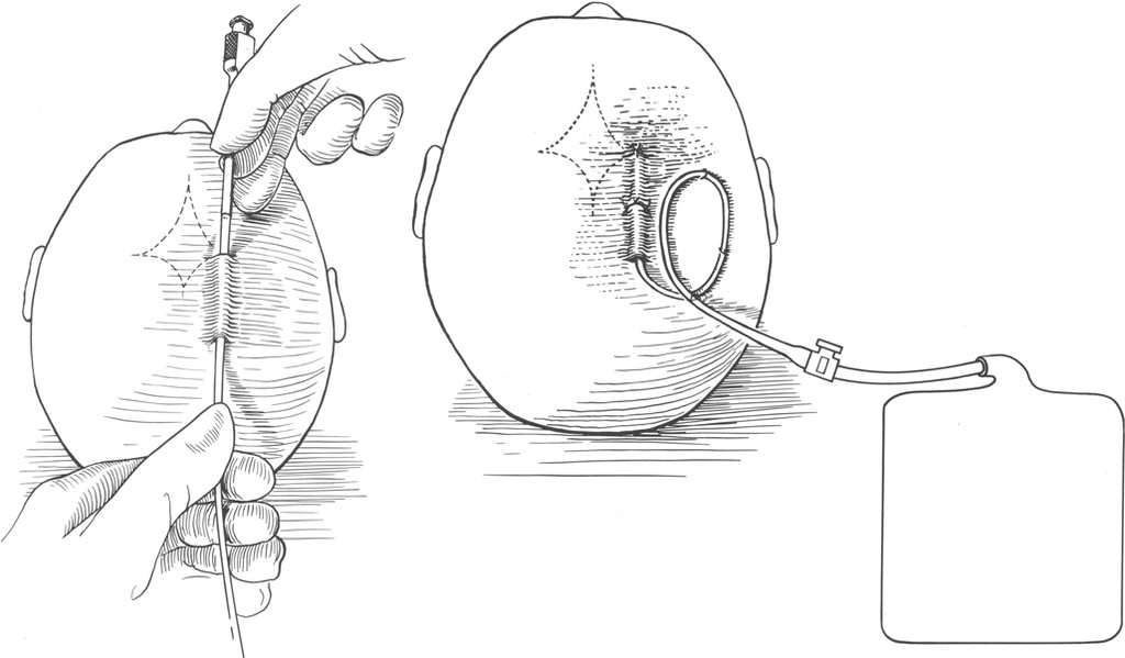 Global External Ventricular Drain Market is Anticipated to Witness High Growth Owing to Rising Prevalence of Hydrocephalus
