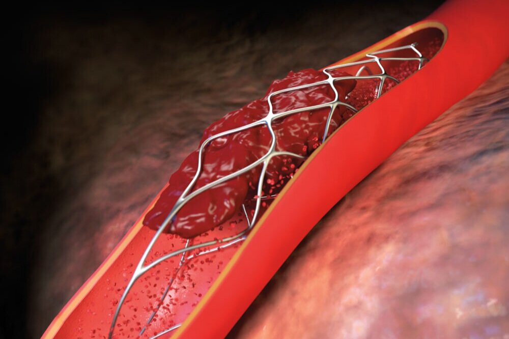 Global Lung Stent Market is Estimated to Witness High Growth Owing to Technological Advancements in Targeted Therapies