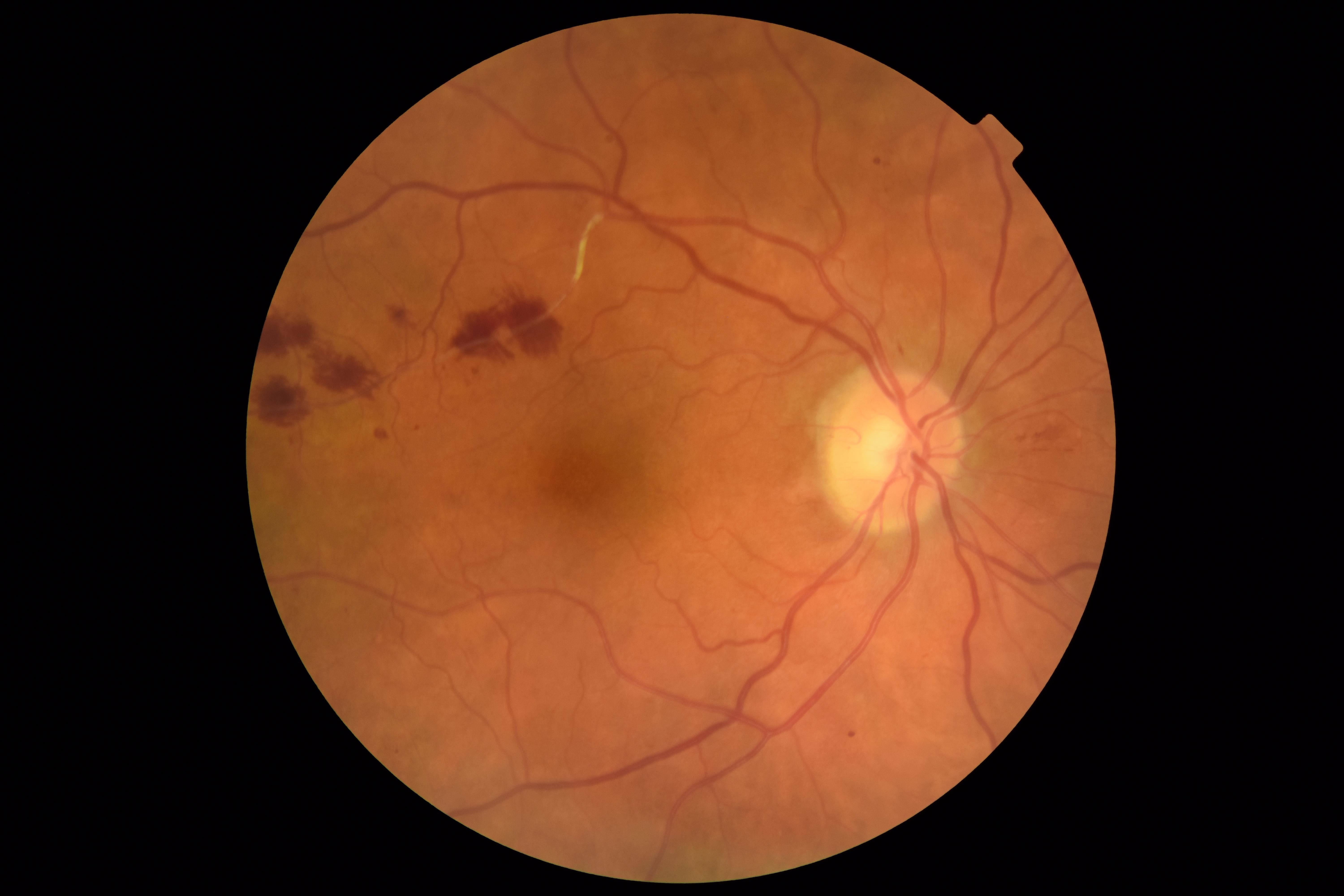 Exploring Global Initiatives in NPHP5 Retinal Degeneration Treatment