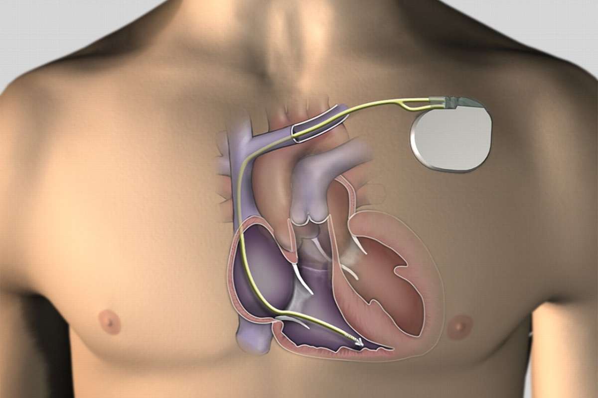 The Global Brazil Cardiac Pacemakers Market Growth Accelerated By Steady Technological Advancements