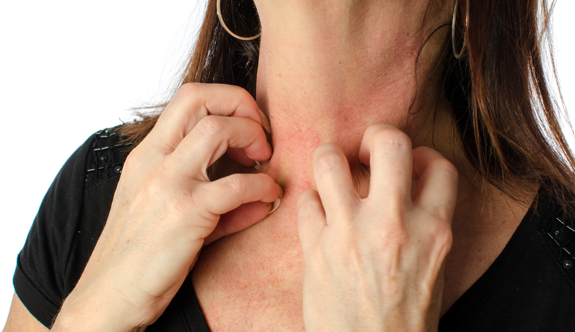 The Pruritus Therapeutics Market Is Driven By Increasing Demand For Innovation In Itch Management