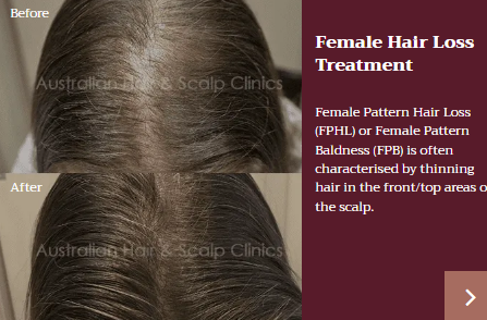 Consult A Reputable Hair Baldness Treatment Clinic to Revitalise Your Look