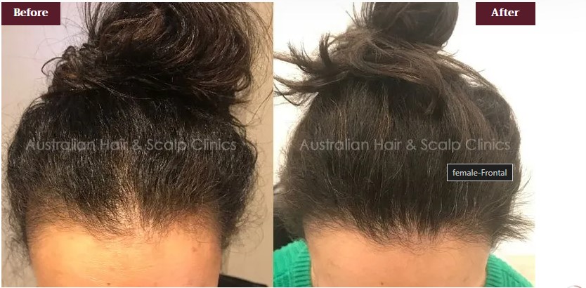 The Herbal Pathway to Cure Female Pattern Baldness in Melbourne 