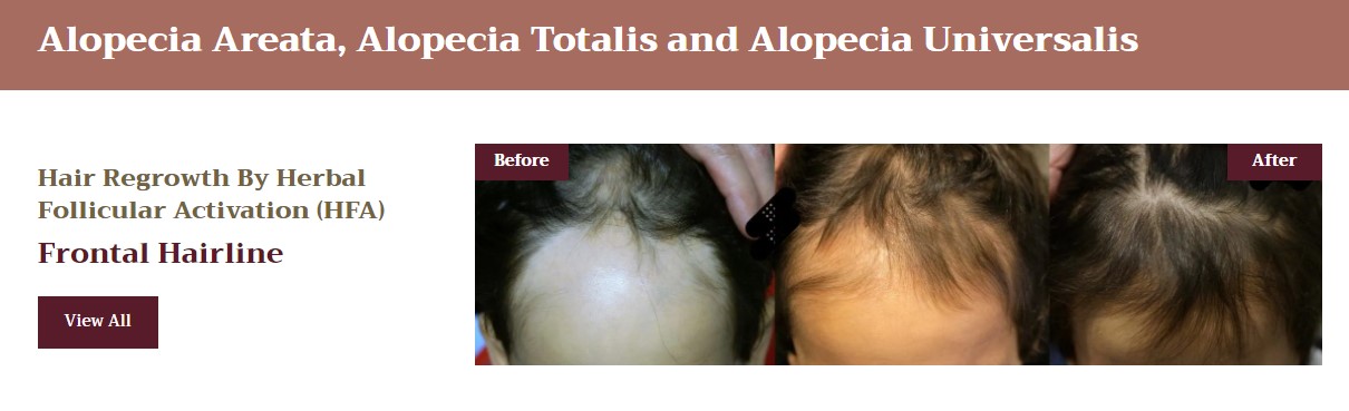 Androgenic Alopecia Cure: A Comprehensive Guide 