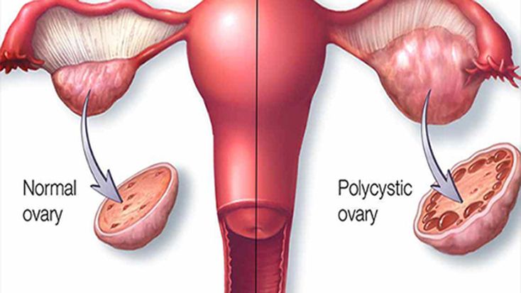 The Polycystic Ovary Syndrome (PCOS) Treatment Market Set to Experience High Growth Due to Rising Prevalence of PCOS