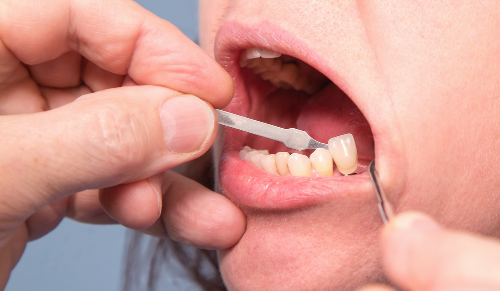 Indications That Your Dental Crowns Aren't Properly Fitted