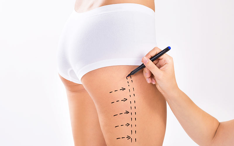Medial Thigh Lift vs. Traditional Thigh Lift: Which Is Right for You?