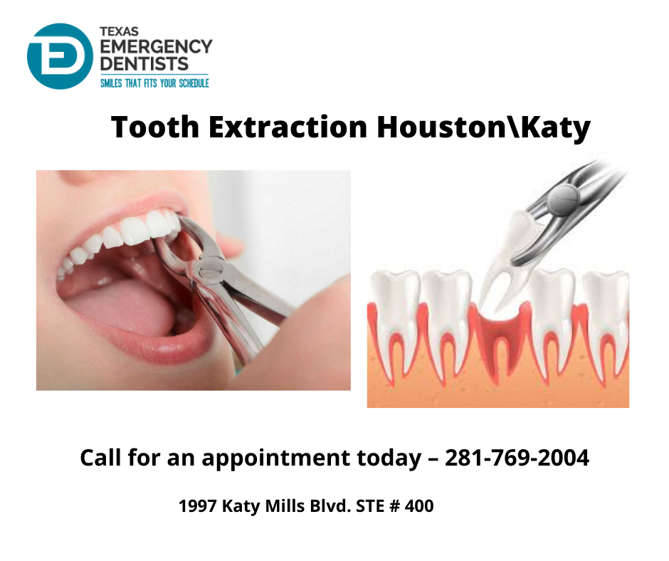 Tooth Extraction Houston Katy
