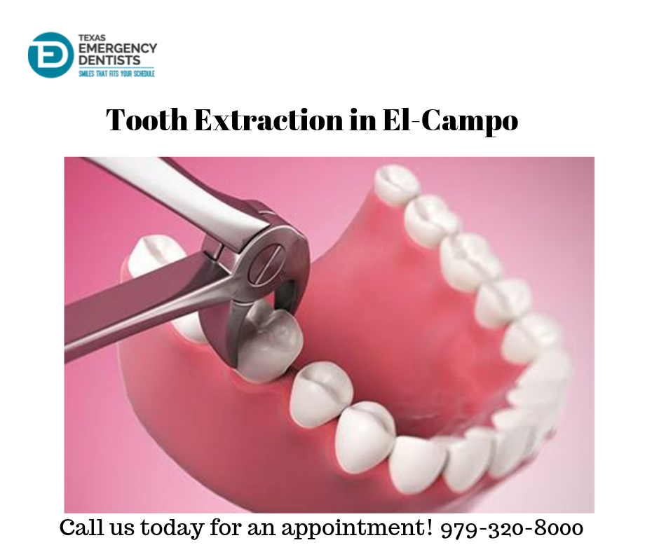Tooth Extraction in Elcampo | Elcampo Modern Dental