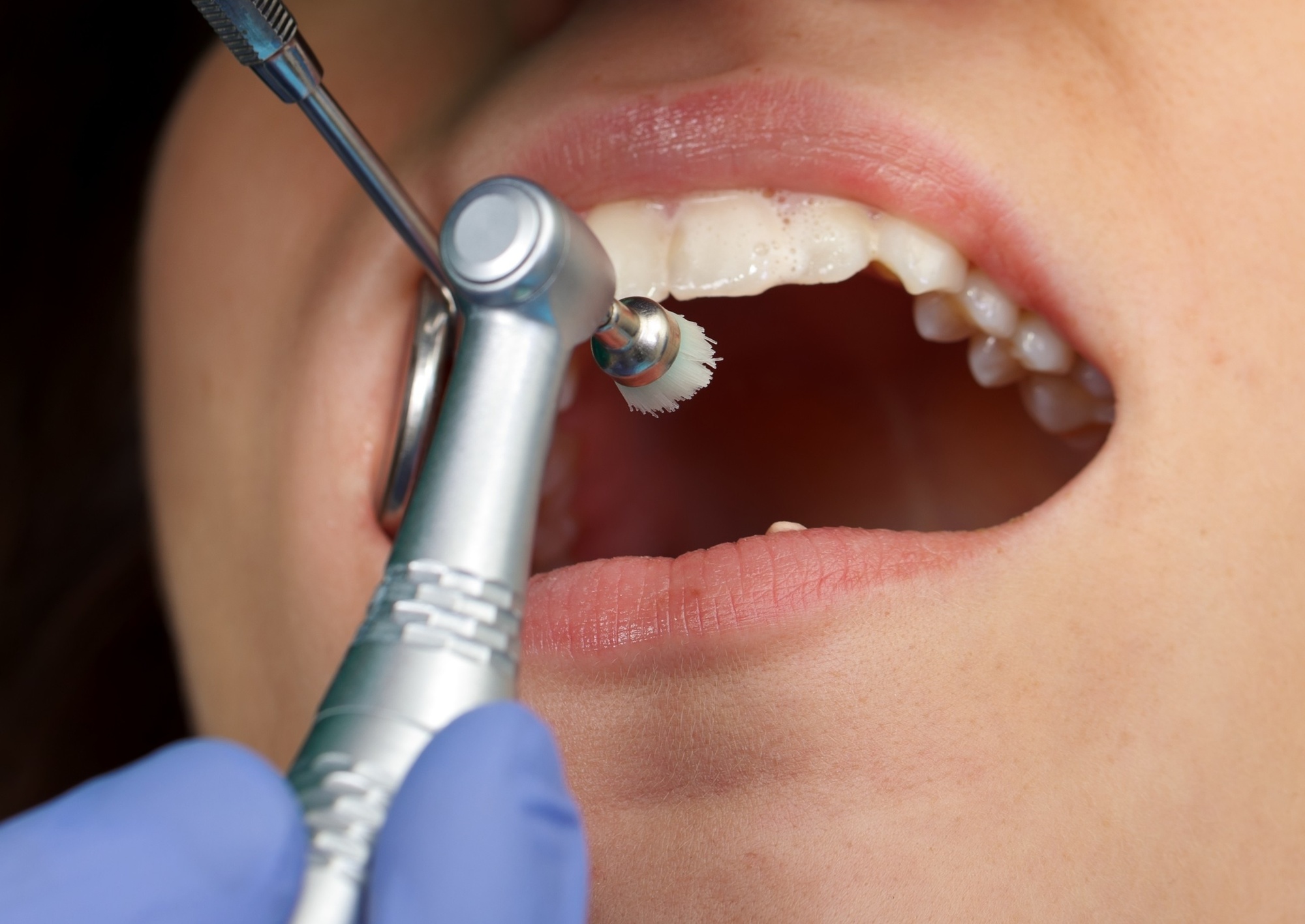 Dental Fluoride Treatment Market Overview, Top Key Players, Growth Analysis by Forecast to 2031