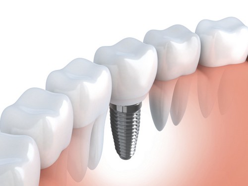 Akeela Dental Care's Commitment to Dental Implant Excellence