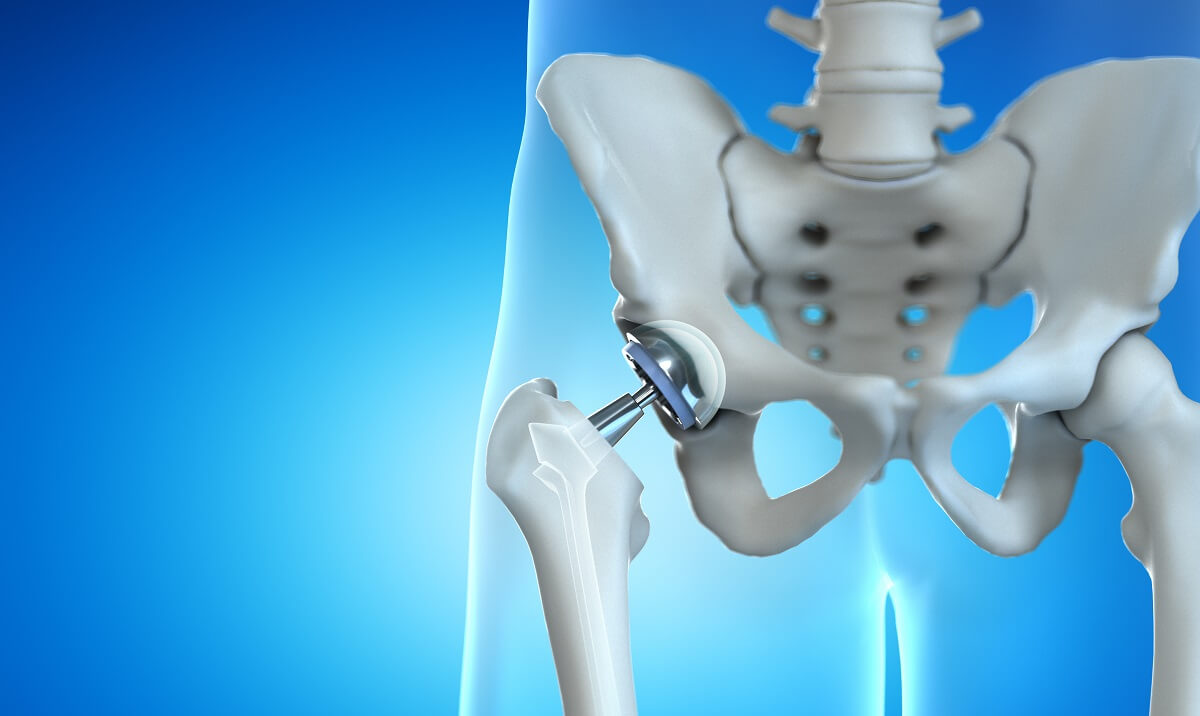 The Complete Guide to Total Hip Replacement: Understanding the Procedure, Recovery, and Long-Term Benefits