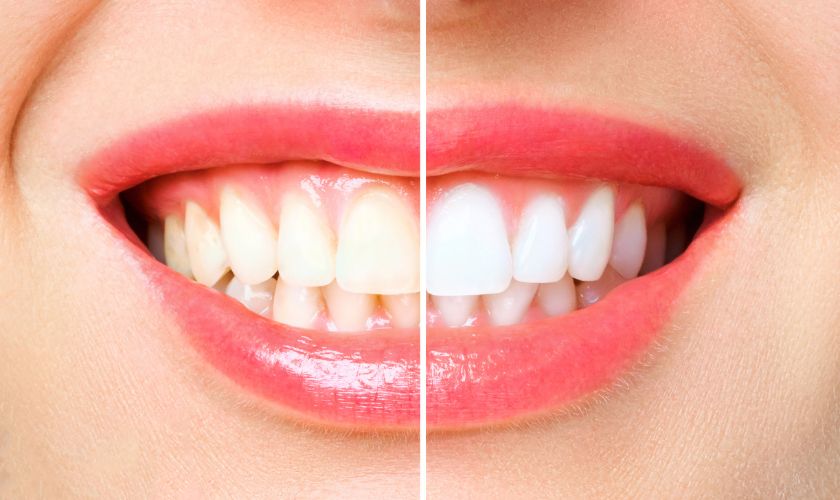 What Is Teeth Whitening? A Complete Beginner’s Guide