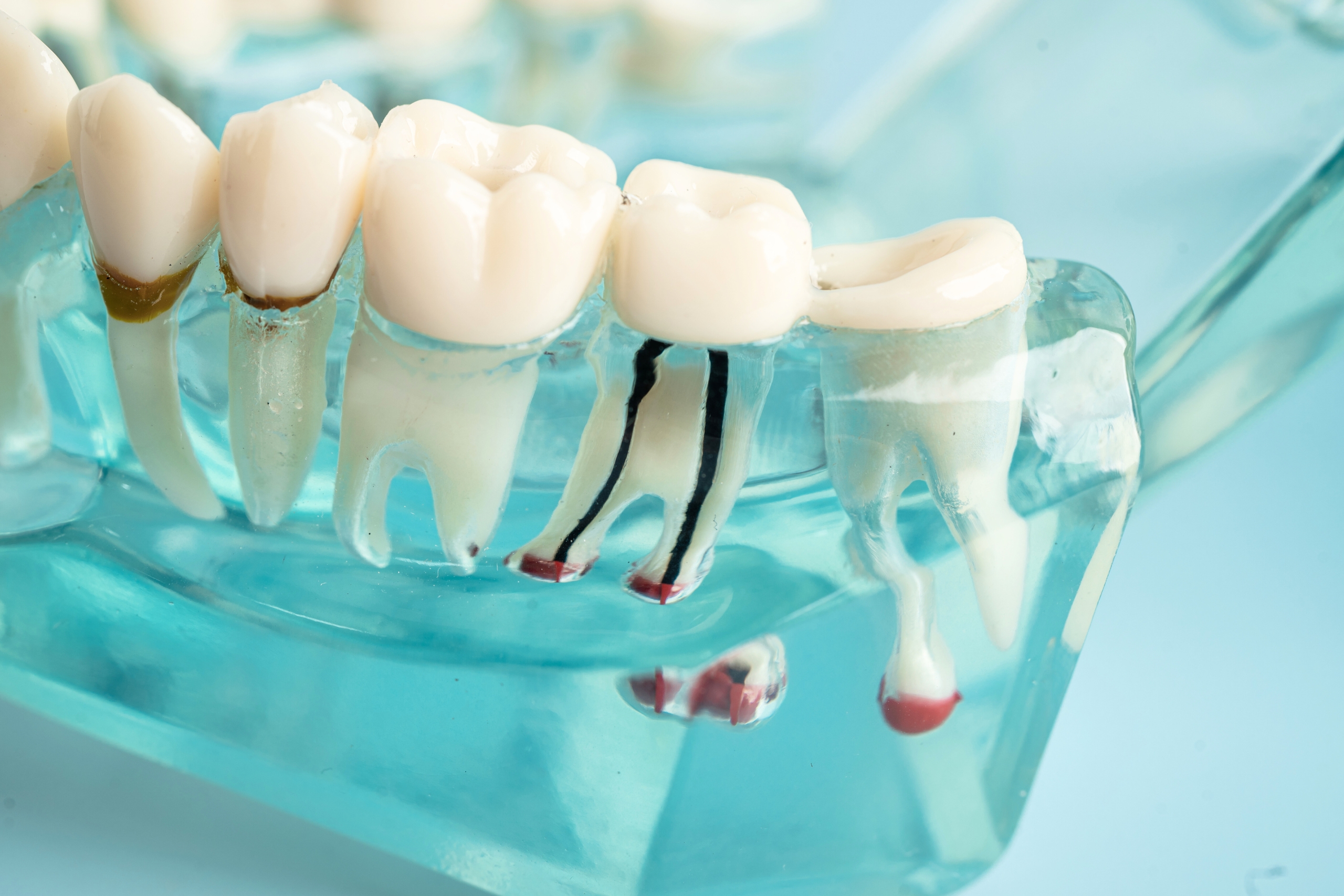 Pain vs Pressure: What You Really Feel During Root Canal Treatment