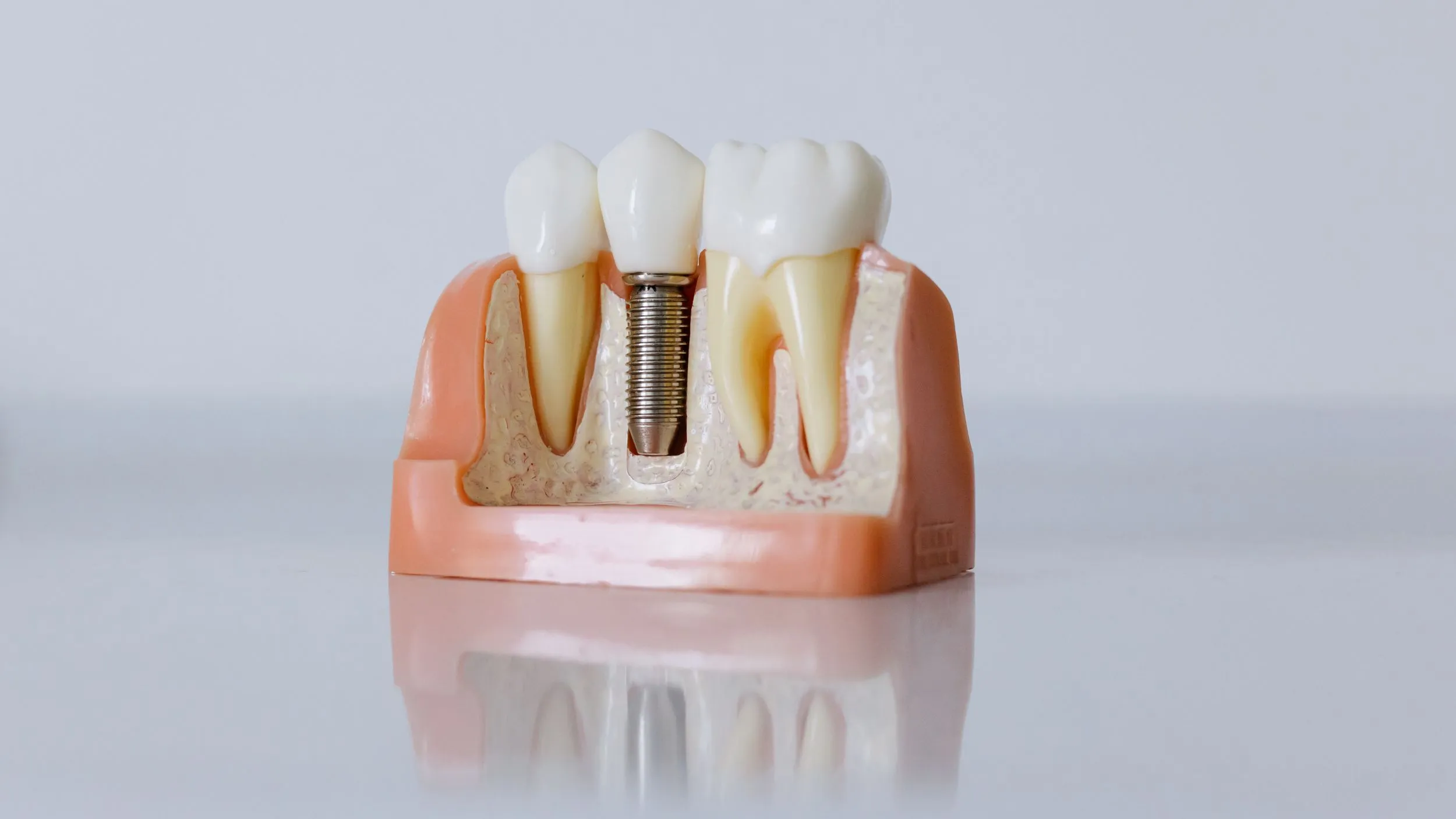 What’s the Best Age for Dental Implants?