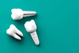 What Makes Dental Implants a Lifetime Solution?