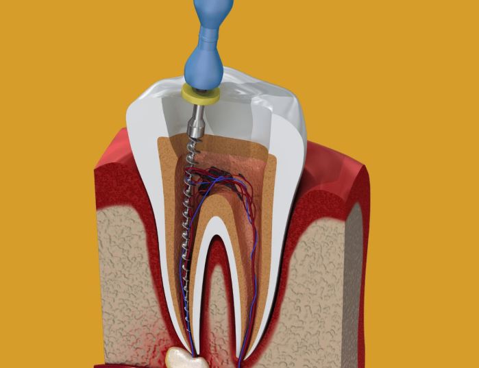 Root Canal Treatment for Children: When Is It Needed?