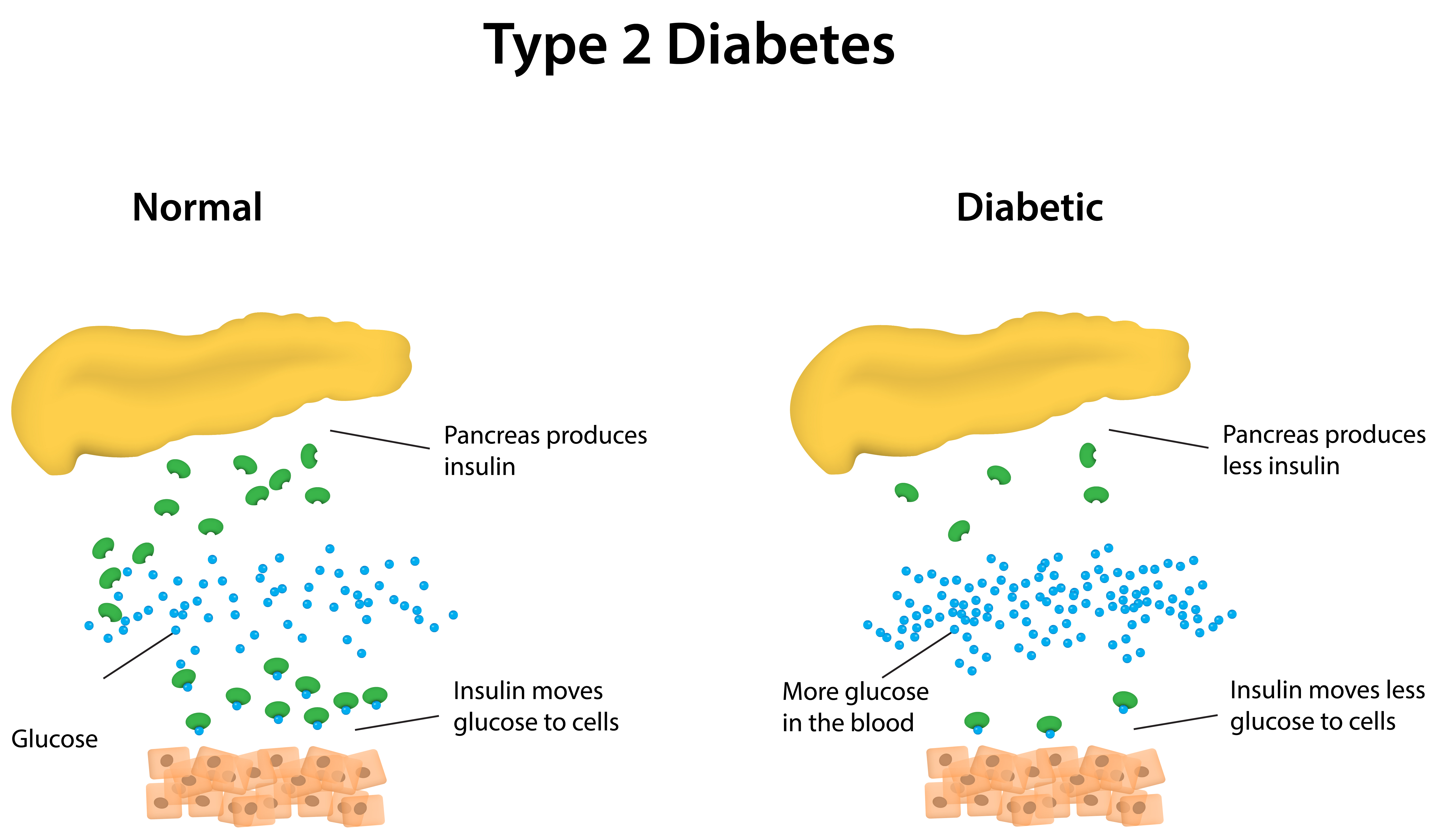 Innovations in Type 2 Diabetes Treatment: The Road to Better Health