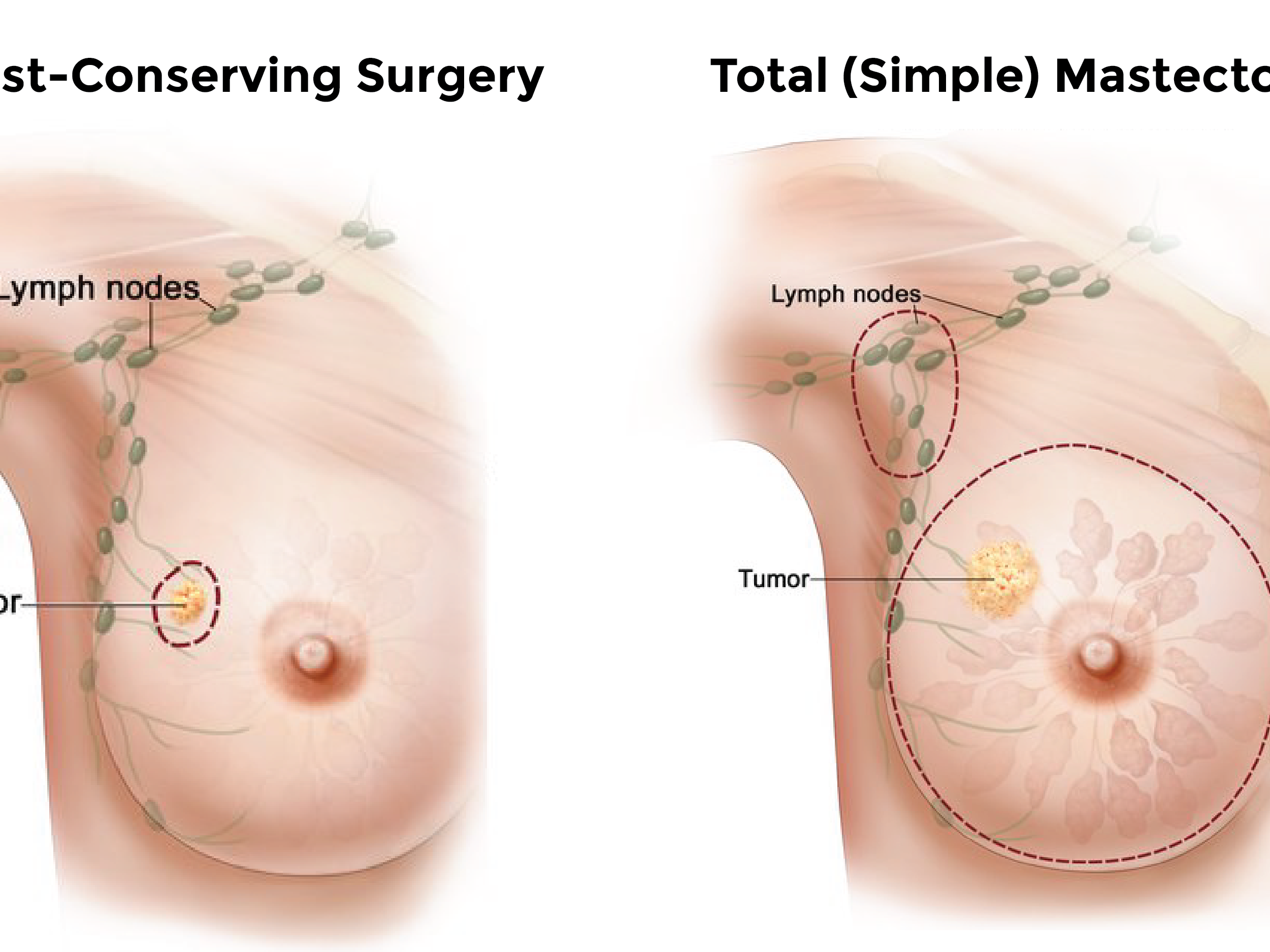 Precision Strikes: Targeted Therapy for Cancer, with a Focus on Advancements in Breast Cancer Treatment