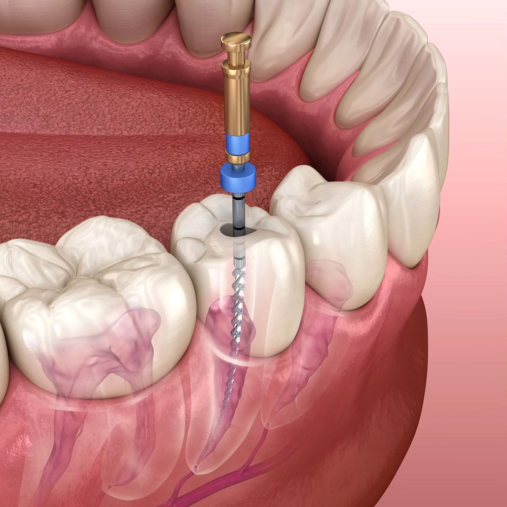 Pain-Free Deep Cleaning Services in Columbia for Lasting Oral Hygiene
