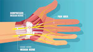 HAND THERAPY IN EDMONTON 