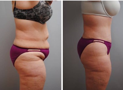 Unlock Your Dream Body: Exploring Mommy Makeover Cost with AESTHETICA LA