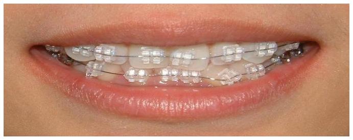 What Determines Braces Price
