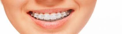 Teeth braces cost in pune