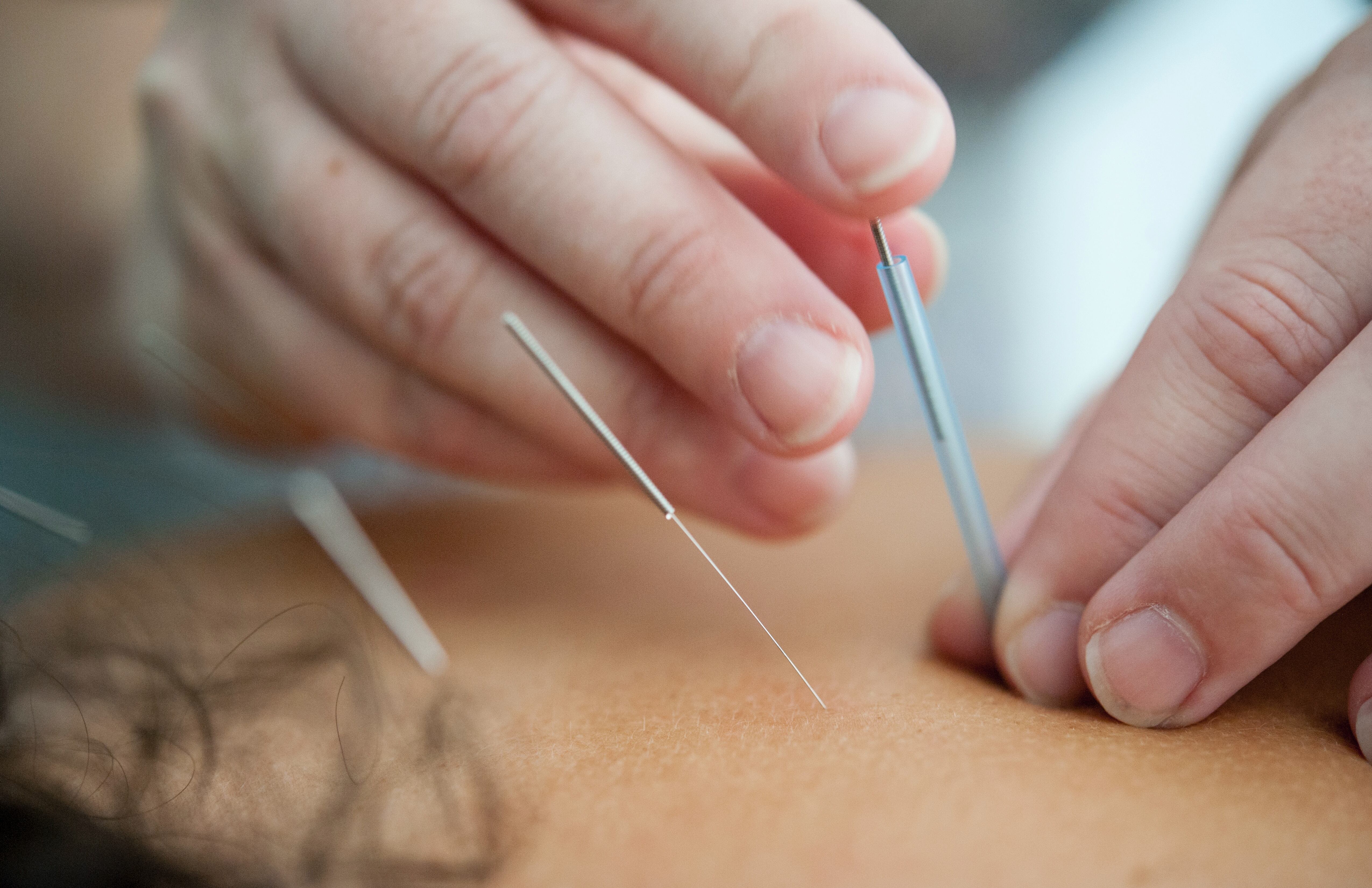 Unlocking Relief from Chronic Pain: The Ancient Art of Acupuncture