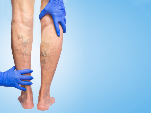 Treating Spider Veins, Finding a Vascular Surgeon, and Managing Leg Ulcers in Dubai