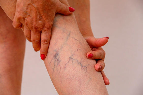Effective Spider Veins Treatment in Dubai: Sclerotherapy and Beyond