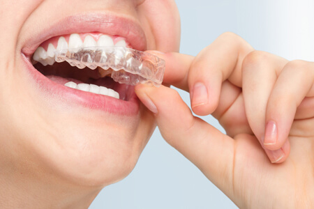 Straighten Your Smile with Invisible Braces