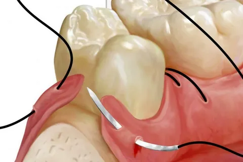 Dental Suture Market is Estimated to Witness High Growth Owing to Opportunity of Growing Geriatric Population