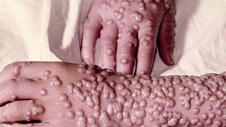 The Smallpox Treatment Market Will Grow At Highest Pace Owing To Rising Investment In Vaccine Development And Production