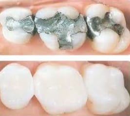 The Art of Restoration: Composite Fillings in Sidcup