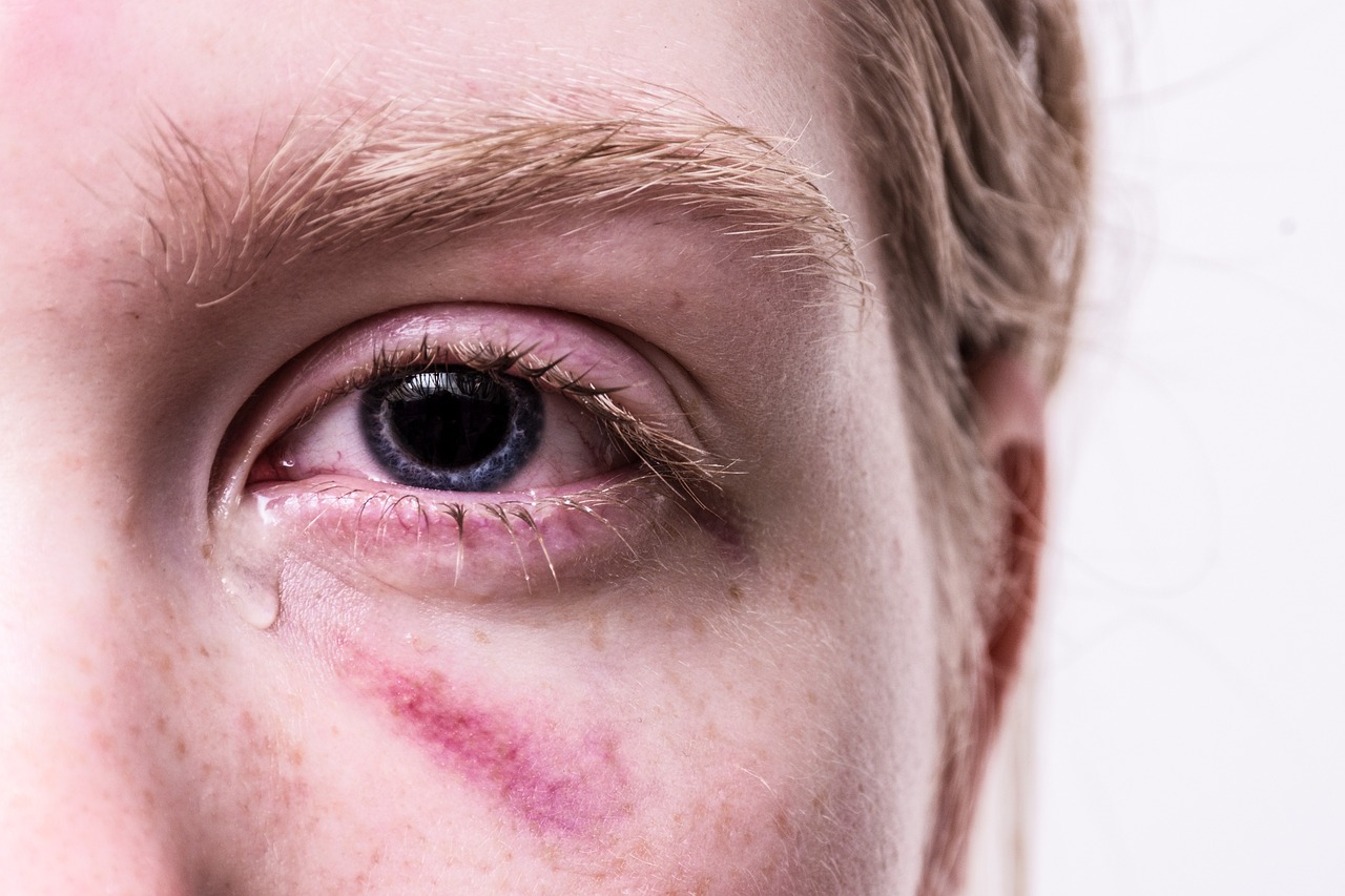 Unmasking Degloved Faces: Understanding the Causes, Management, and Rehabilitation