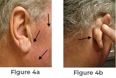Parotid Tumor: Causes, Symptoms, Diagnosis, and Treatment