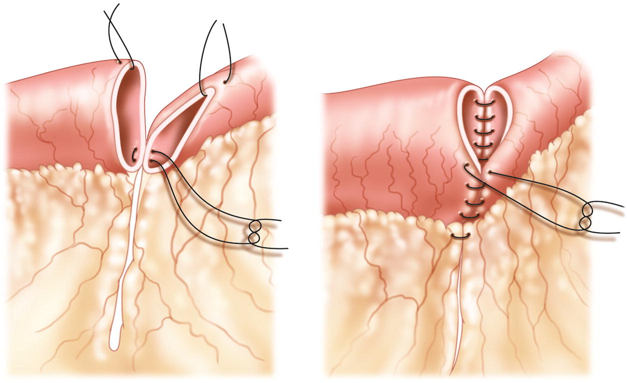 Mastering the Art of Anastomosis: A Deep Dive into Types and Benefits of Advanced Anastomosis Devices