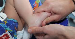 Method Ponseti for clubfoot